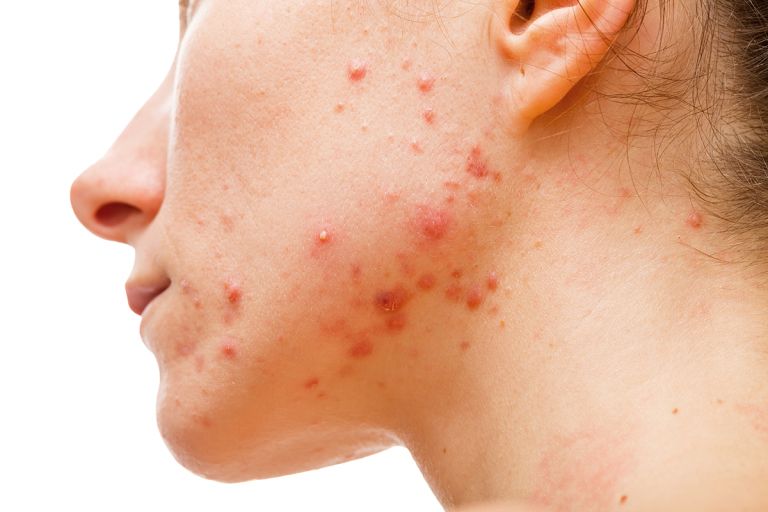 PCOD acne is usually more stubborn in nature. 