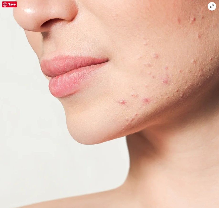 PCOD Acne is prevalent around the Jawline