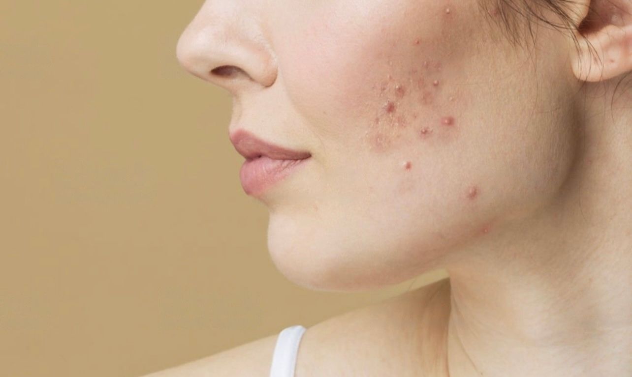 Acne-Free Diet: How Nutrition Can Help Clear Your Skin