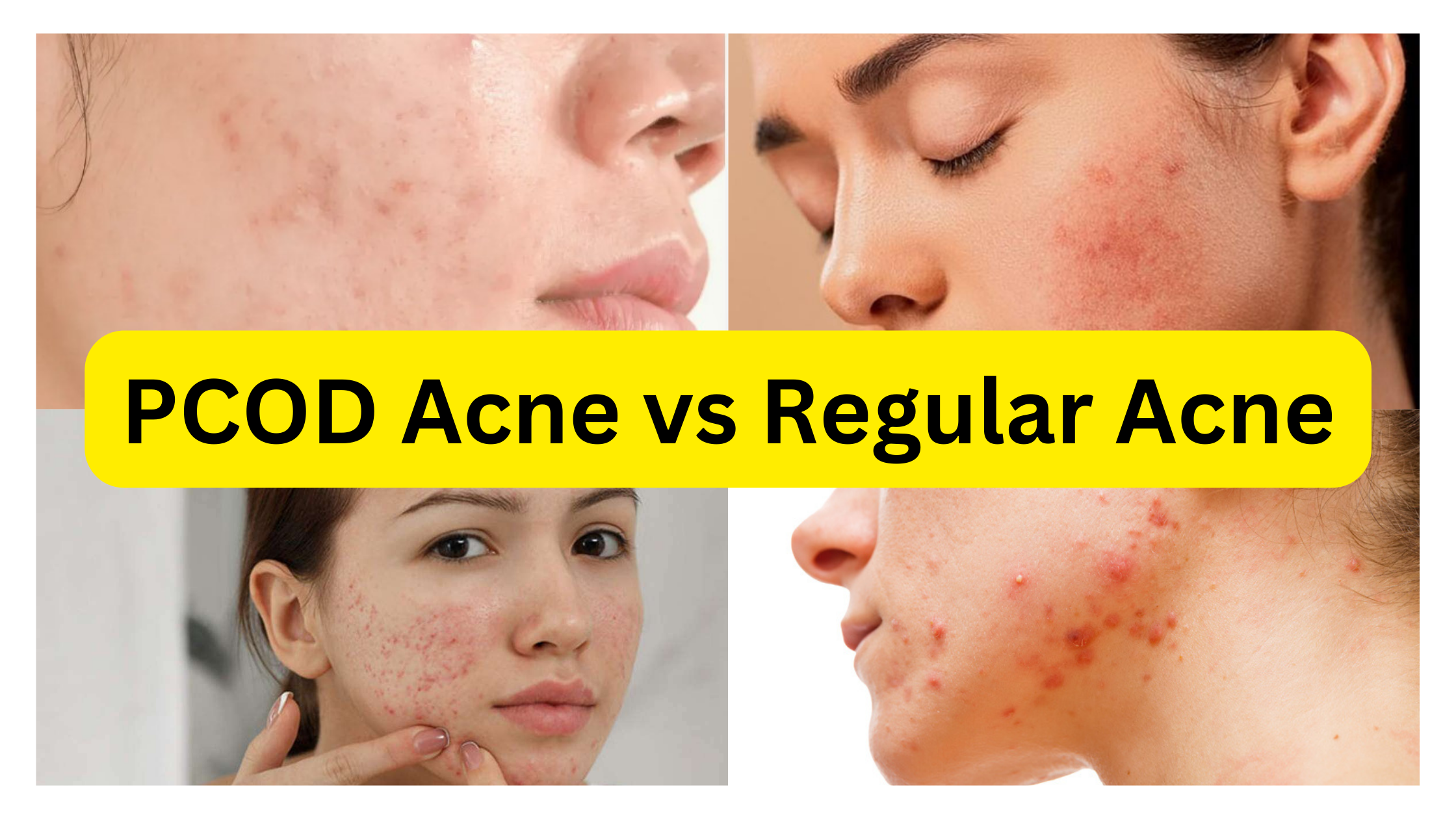 PCOD Acne Vs Regular Acne. Understanding the differences