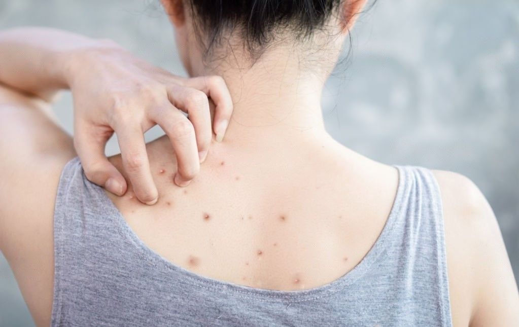 Body Acne: Everything You Need to Know