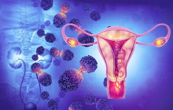 Understanding Endometriosis: The Role of Diet in Managing Symptoms